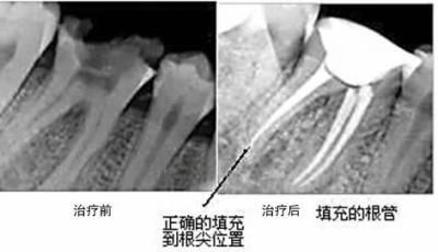 根管治療案例3